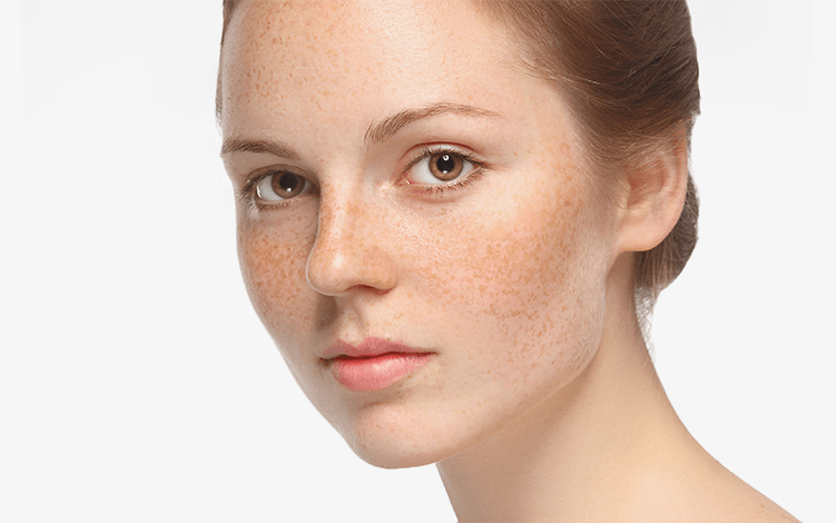 Manchas na pele: tipos e cuidados específicos para cada um