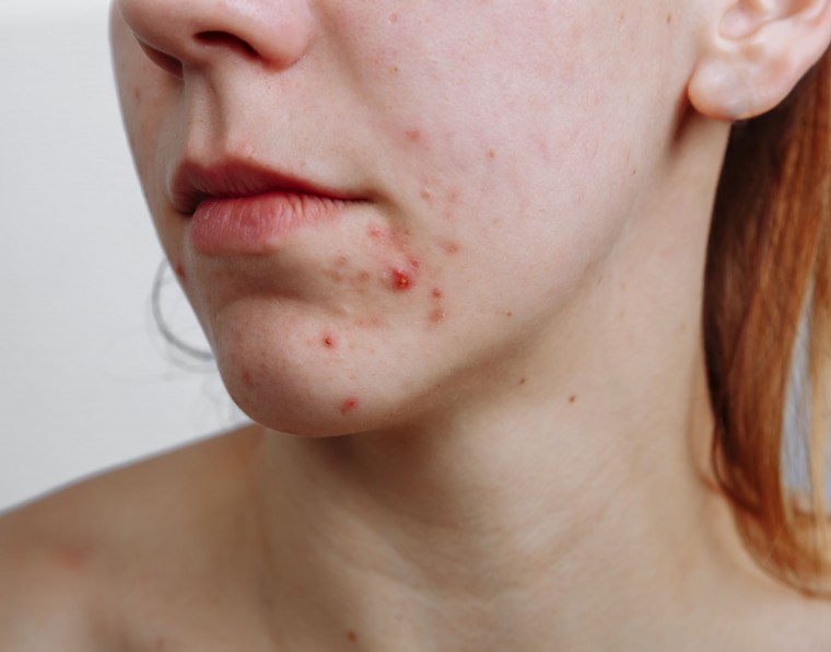 adcos_cicatriz de acne